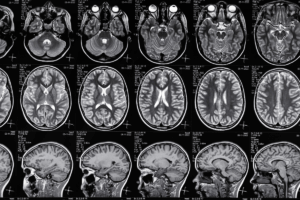 South Africa's first clinical trial testing psilocybin, Ithemba Newsletter Q3